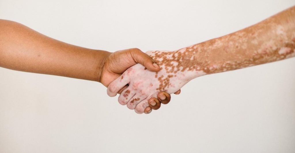 ¿Por qué importa hablar del vitiligo? Datos y cómo entender la enfermedad